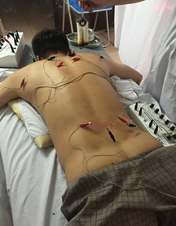 Bệnh nhân bị đau cổ gáy do co cơ và bị thoái hóa đốt sống cổ