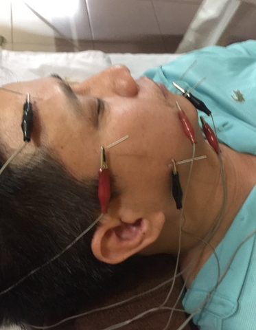 Bệnh nhân bị liệt 7 ngoại biên